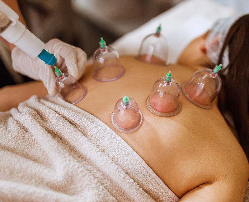 16554 cupping therapy