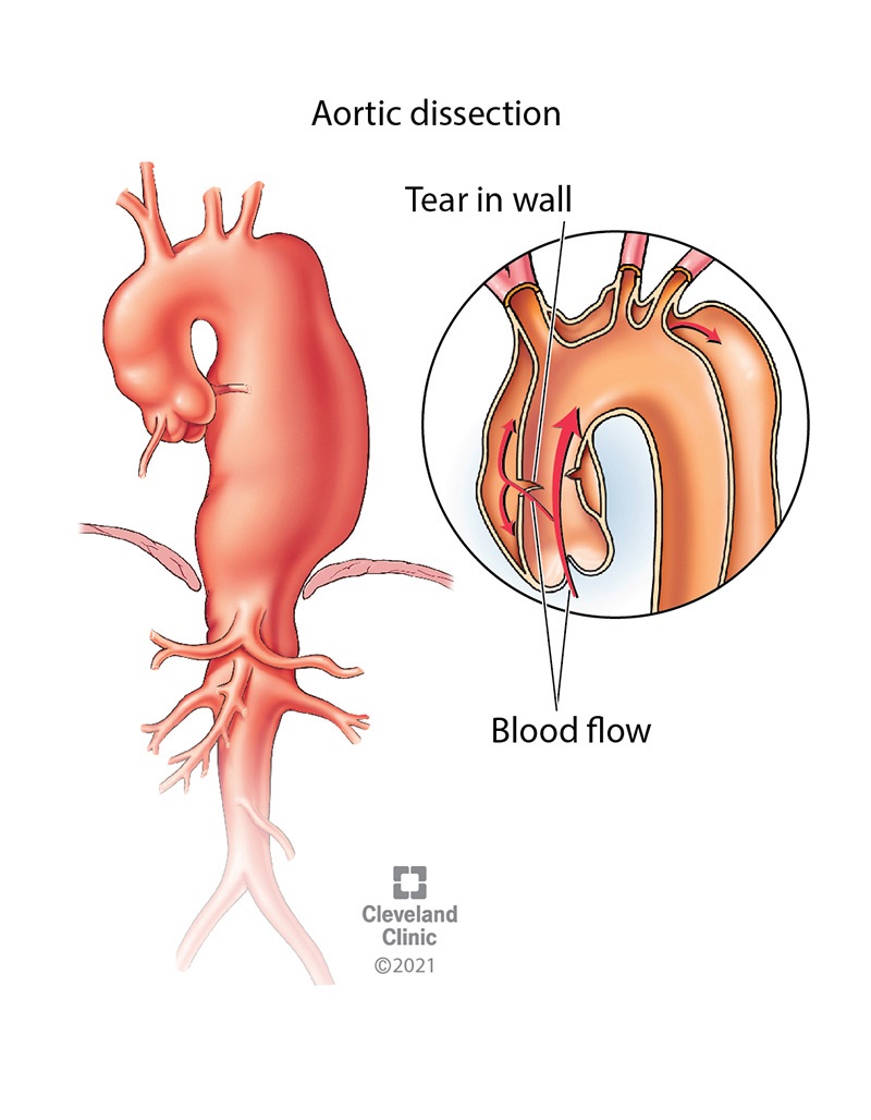 La dissezione aortica è una lacerazione nello strato interno della parete aortica.  Il sangue scorre attraverso la lesione, causando una separazione tra gli strati della parete, un rigonfiamento nell'aspetto dell'arteria e debolezza in quella zona dell'aorta.