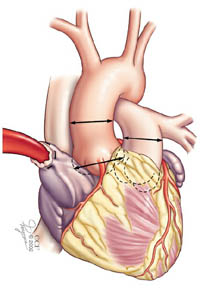 16744 aortic valve ross procedure 1