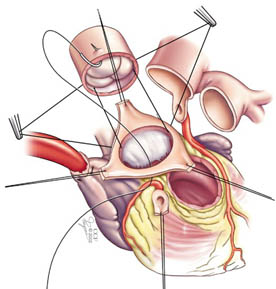 Illustrazione medica che mostra come le valvole aortica e polmonare vengono scambiate nella procedura di Ross.