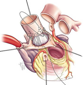 L'illustrazione mostra come le arterie coronarie vengono riattaccate come parte della procedura di Ross.
