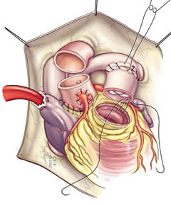 Illustrazione che mostra la posizione dell'omoinnesto polmonare in una procedura di Ross.