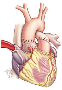 Immagine che mostra le linee di sutura nella fase finale della procedura di Ross.