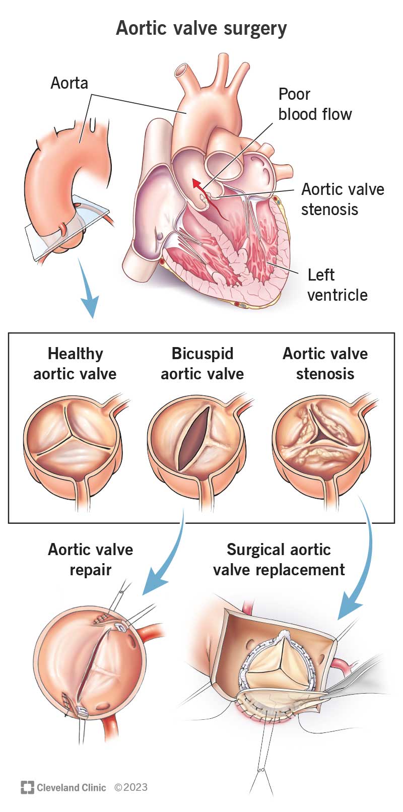 Riparazione e sostituzione della valvola aortica.