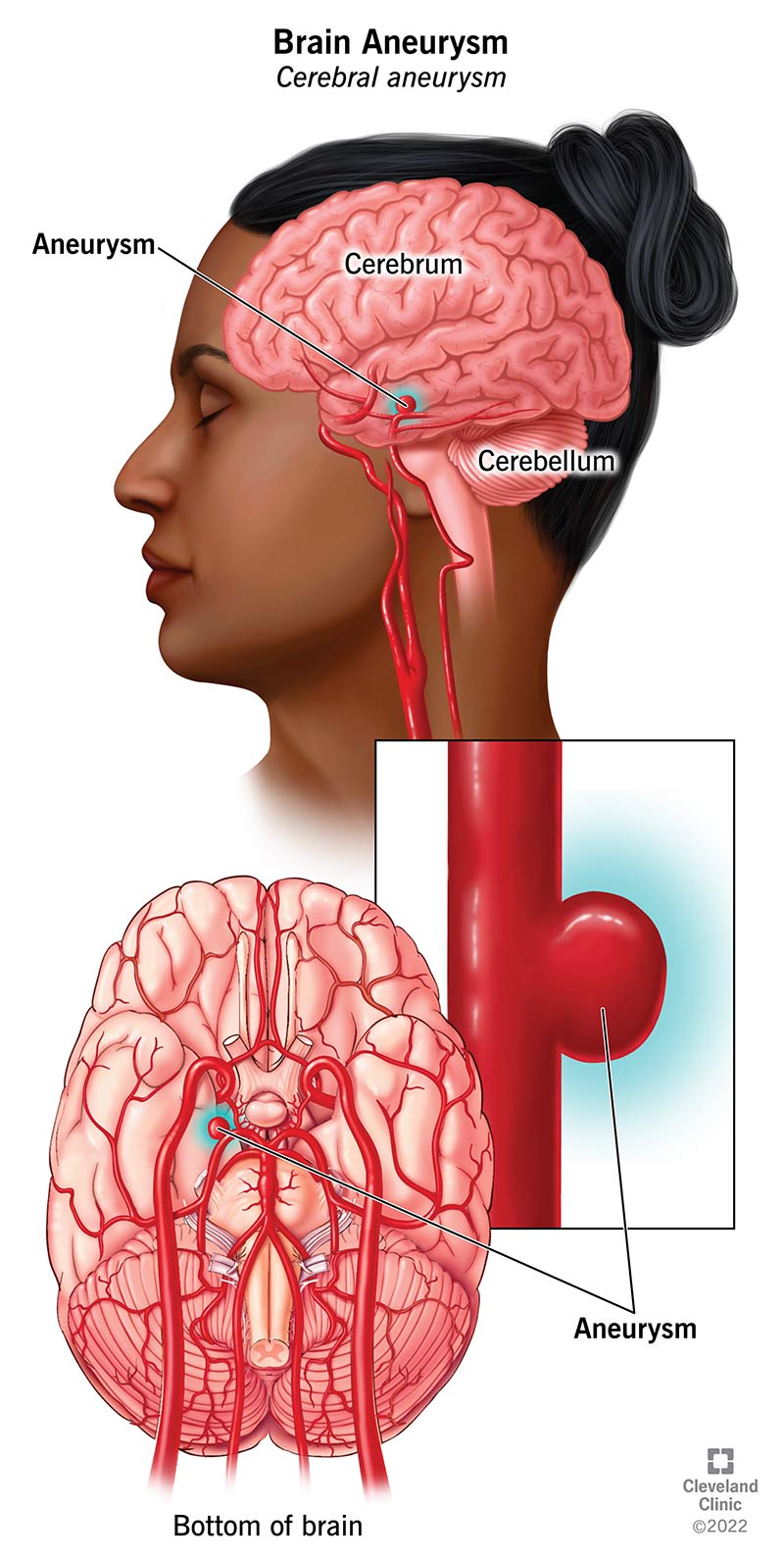 Un cervello con un'arteria, che evidenzia un rigonfiamento nell'arteria.