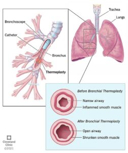 16811 bronchial thermoplasty