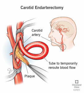 16849 carotid endarterectomy illustration