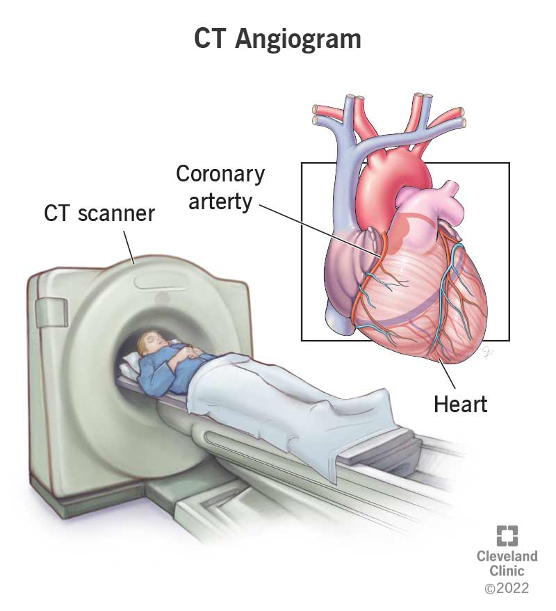 16899 ct angiogram