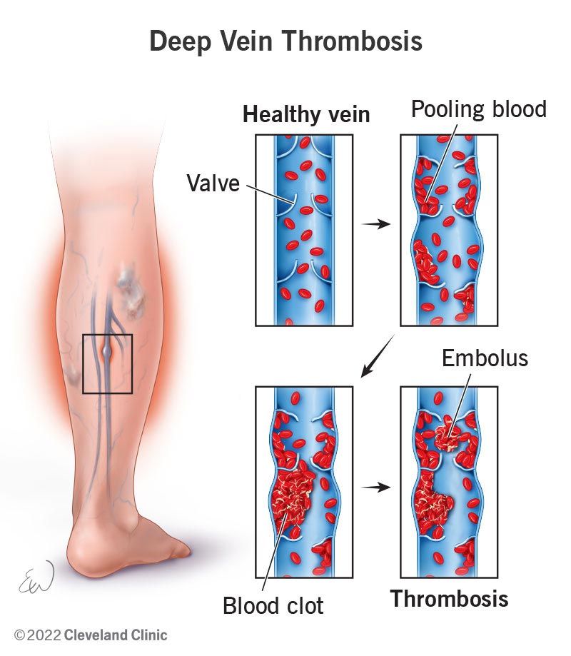 16911 deep vein thrombosis