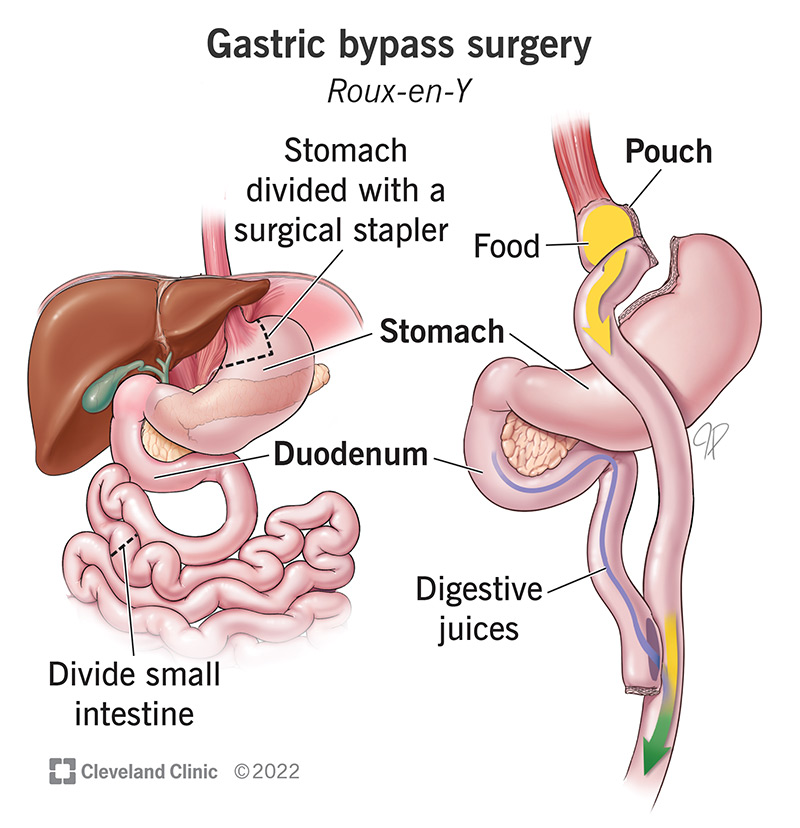 17157 gastric bypasss surgery