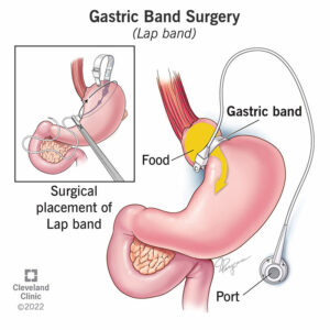 17163 gastric band surgery