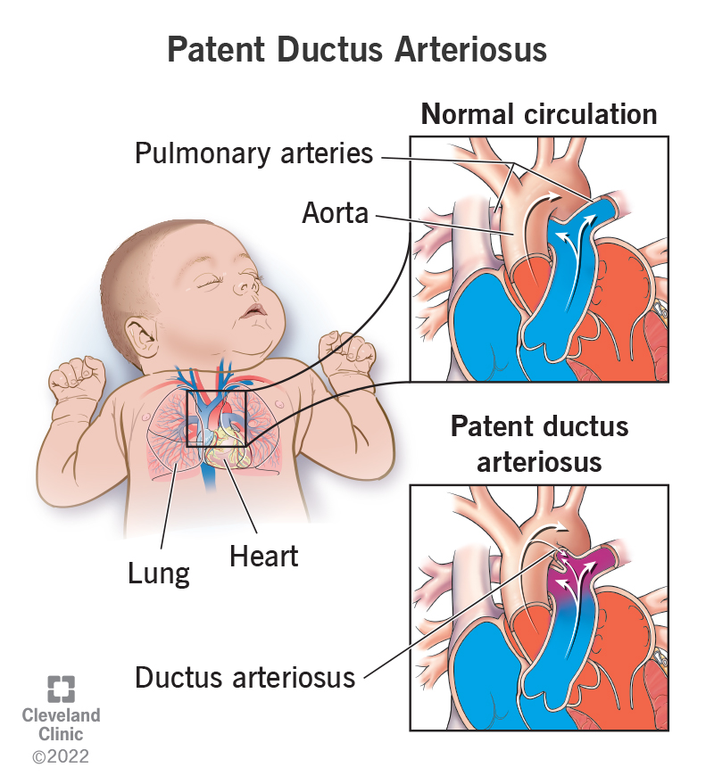 17325 patent ductus arteriosus