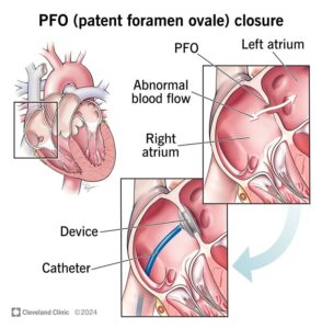 17326 patent foramen ovale