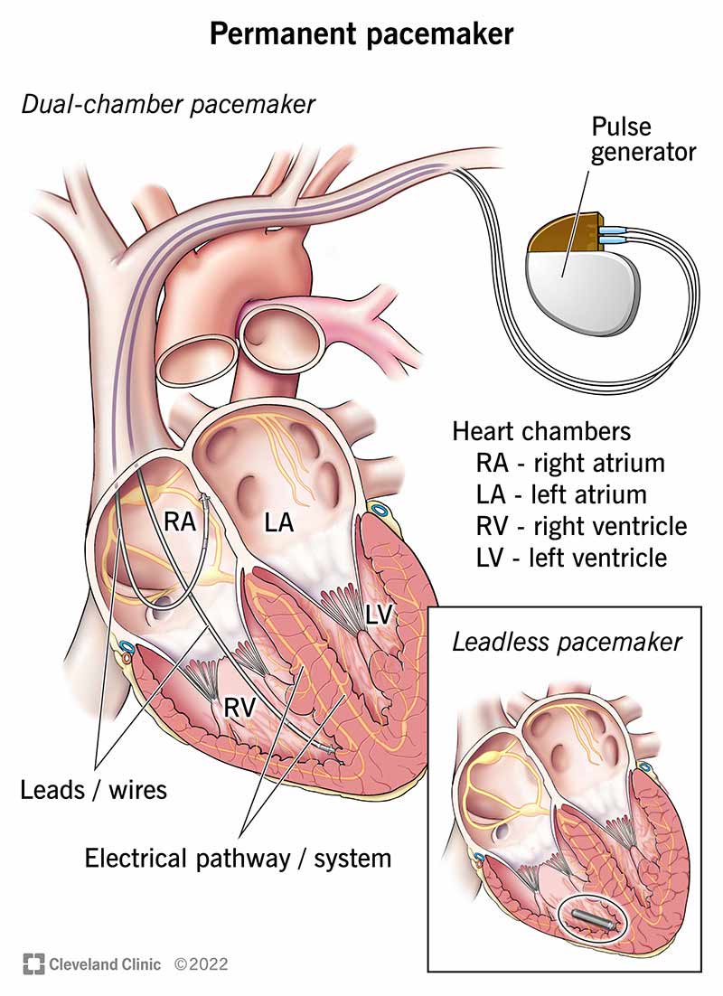 Esempi di pacemaker permanenti per aiutare il cuore a battere con un ritmo normale.