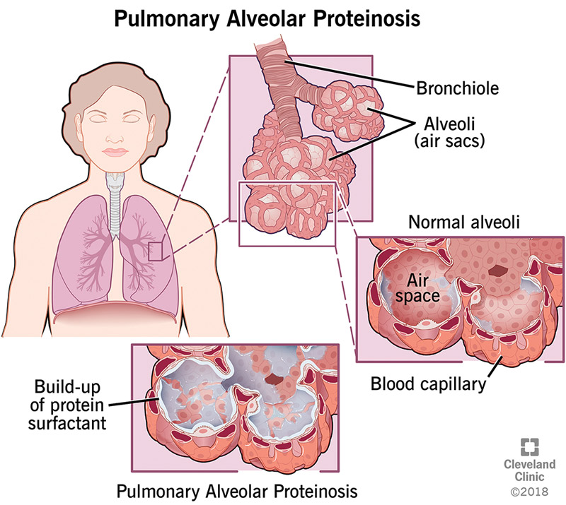 17398 pulmonary alveolar proteinosis pap