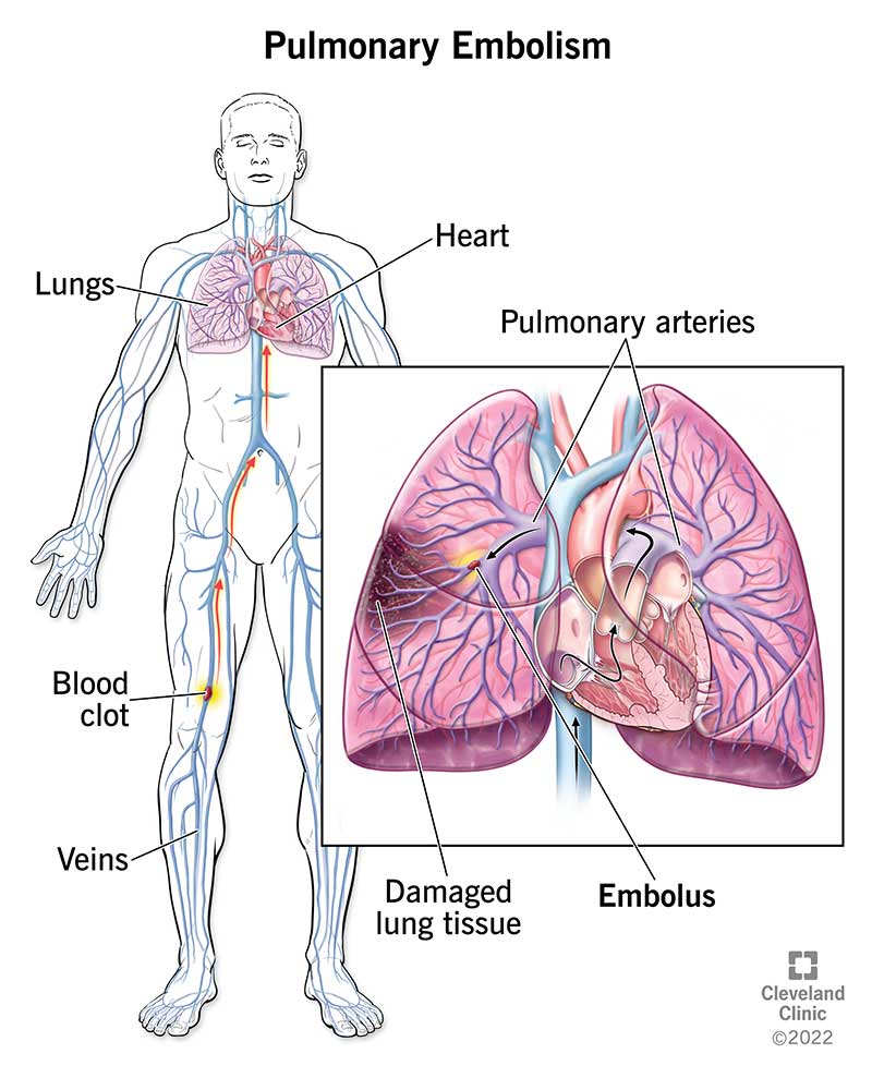 Un coagulo di sangue diventa un'embolia polmonare quando viaggia dalla gamba al polmone