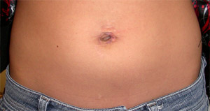 foto dell'addome dopo un intervento chirurgico a porta singola che mostra poche cicatrici