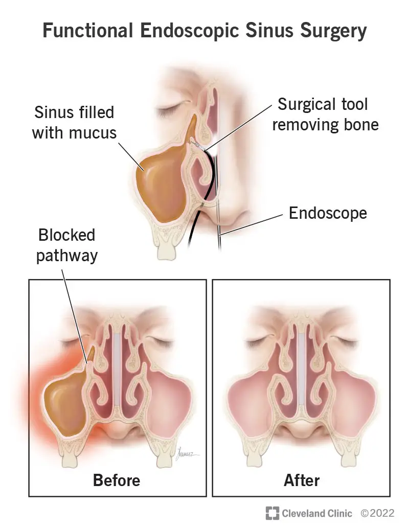 La chirurgia endoscopica funzionale del seno (FESS) è una procedura minimamente invasiva utilizzata per sbloccare le aperture del seno.