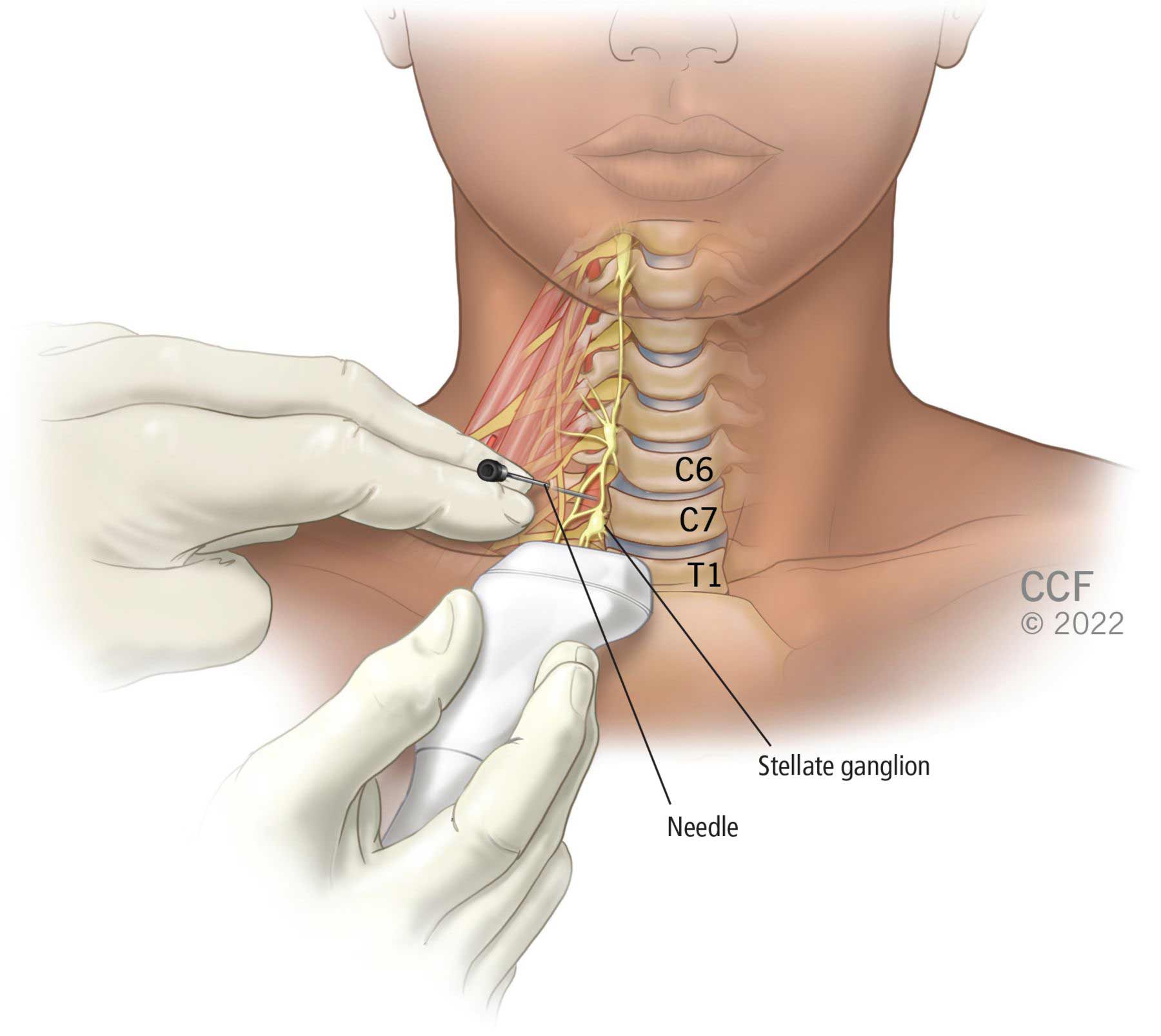 La posizione anatomica del ganglio stellato è sulla parte anteriore del collo, vicino alle vertebre C7 e T1.