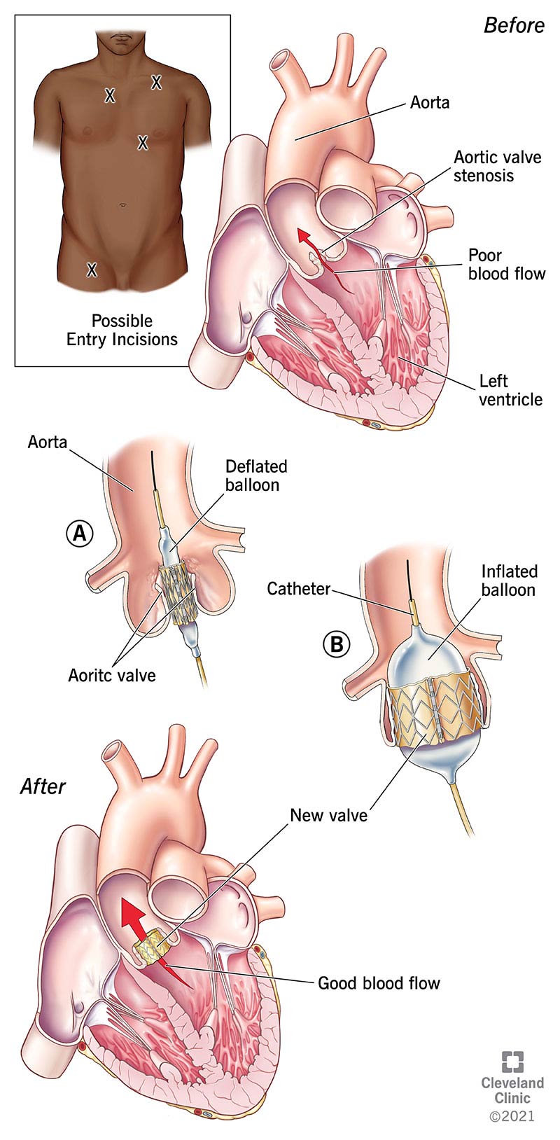 Come la TAVR sostituisce una valvola aortica dall'interno.