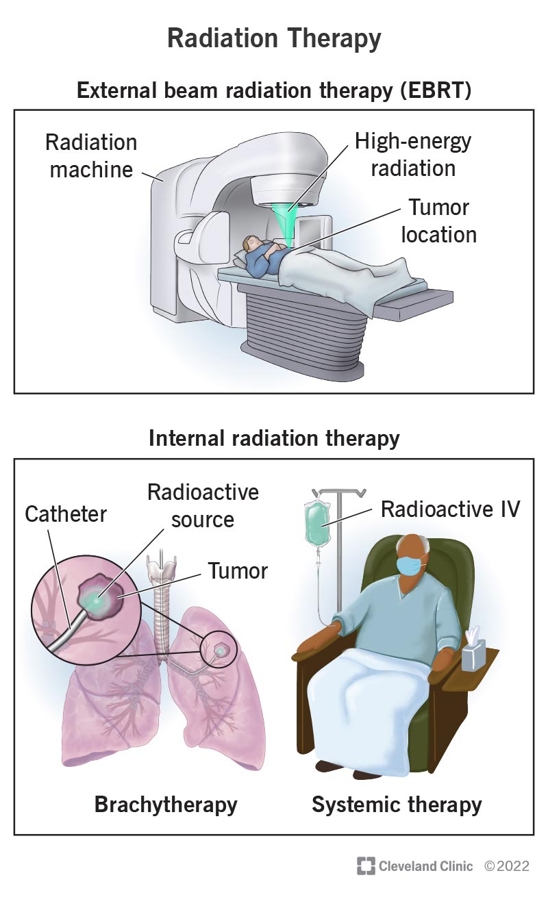 Metodi di somministrazione della radioterapia, tra cui EBRT, brachiterapia e terapia sistemica