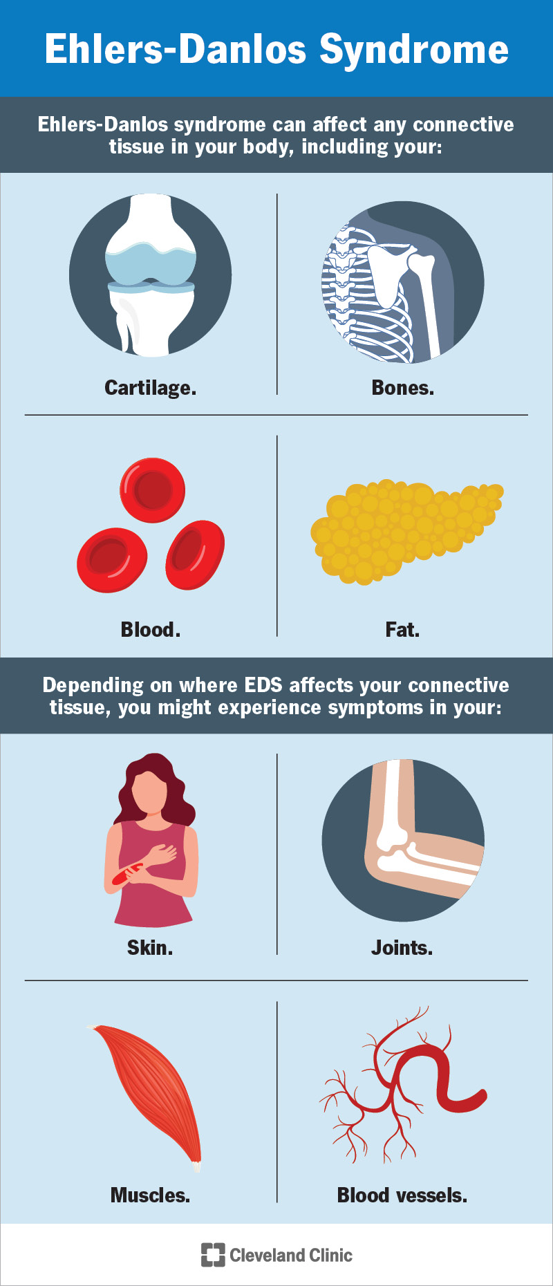 La sindrome di Ehlers-Danlos può colpire i tessuti di tutto il corpo e causare molti sintomi diversi.
