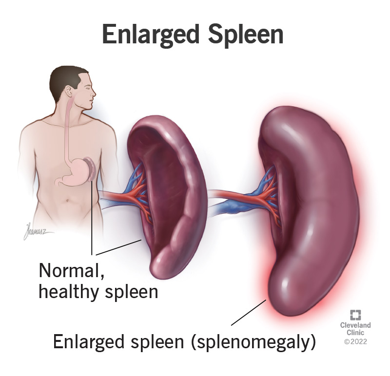 17829 enlarged spleen