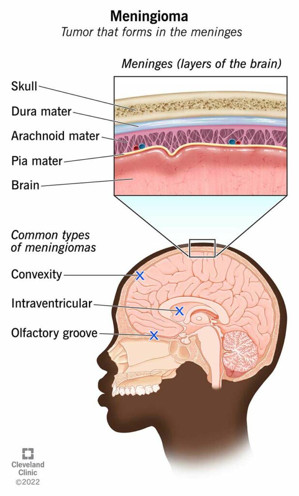 17858 meningioma