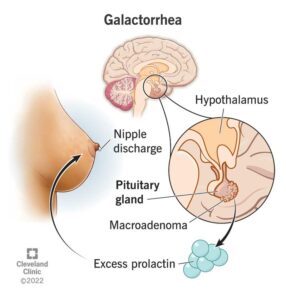 17924 galactorrhea