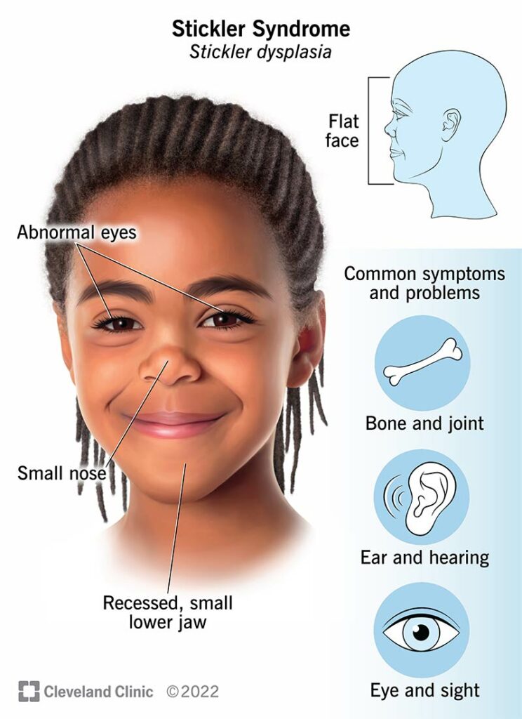 17987 stickler syndrome