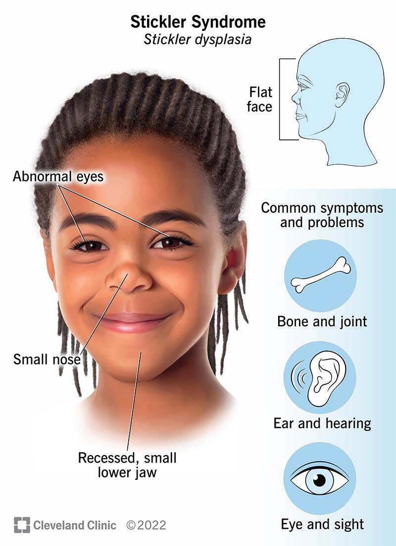 Un'illustrazione dei sintomi che colpiscono un bambino con diagnosi di sindrome di Stickler.