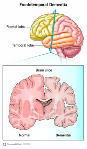 21075 frontotemporal dementia