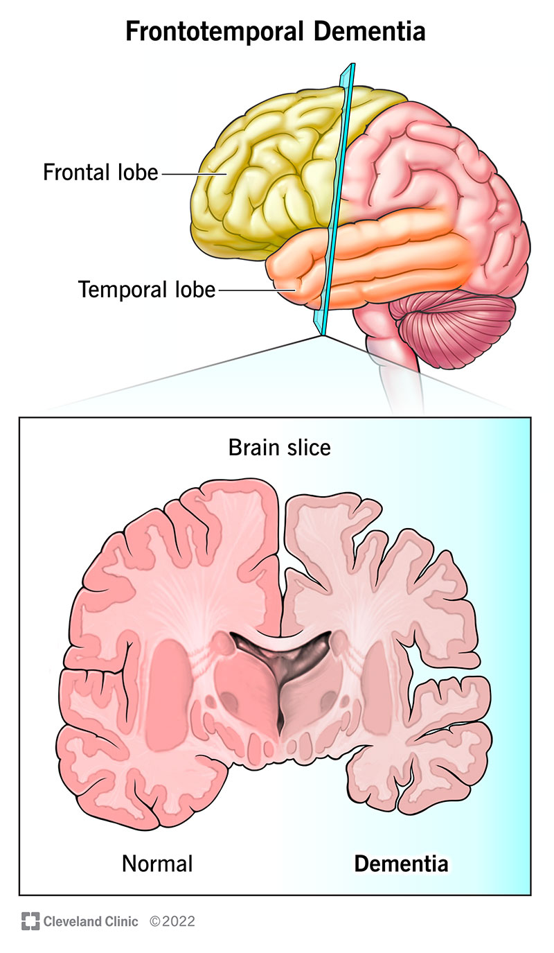 Il tessuto cerebrale si deteriora nei lobi frontali (anteriori) e temporali (laterali) del cervello quando si soffre di demenza frontotemporale.