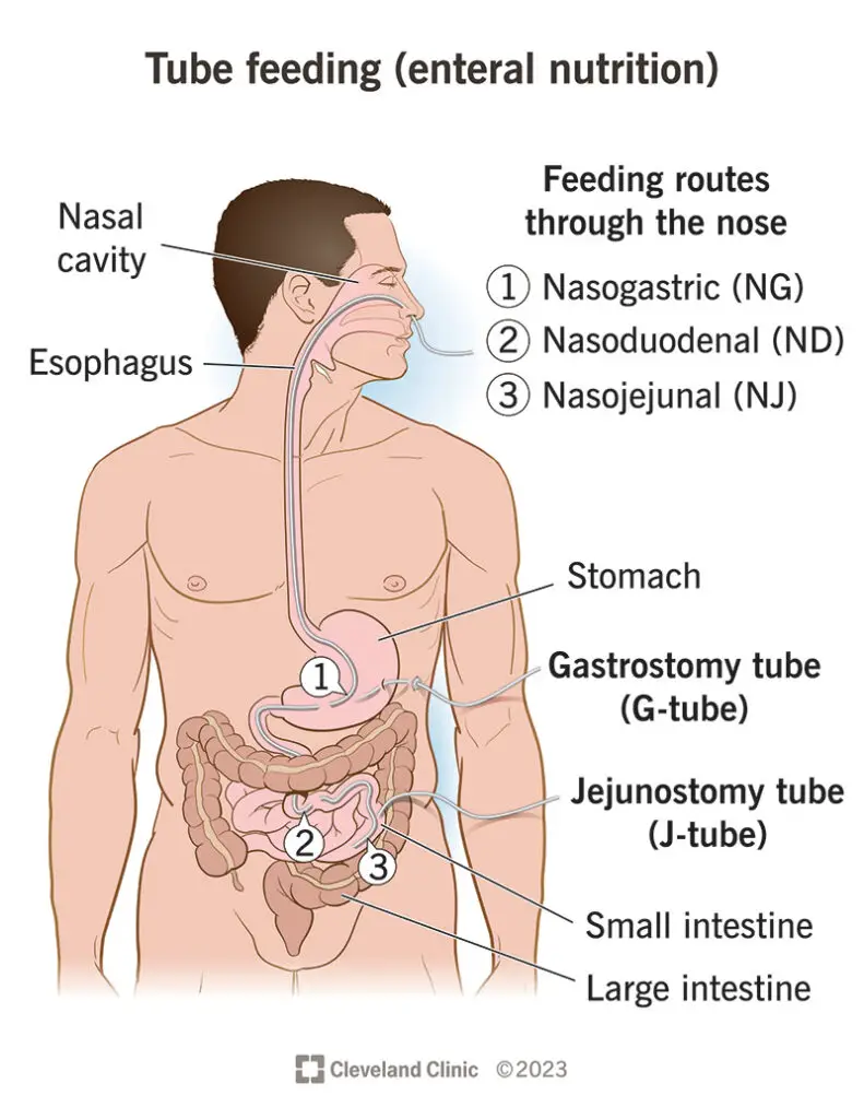 21098 tube feeding enteral nutrition