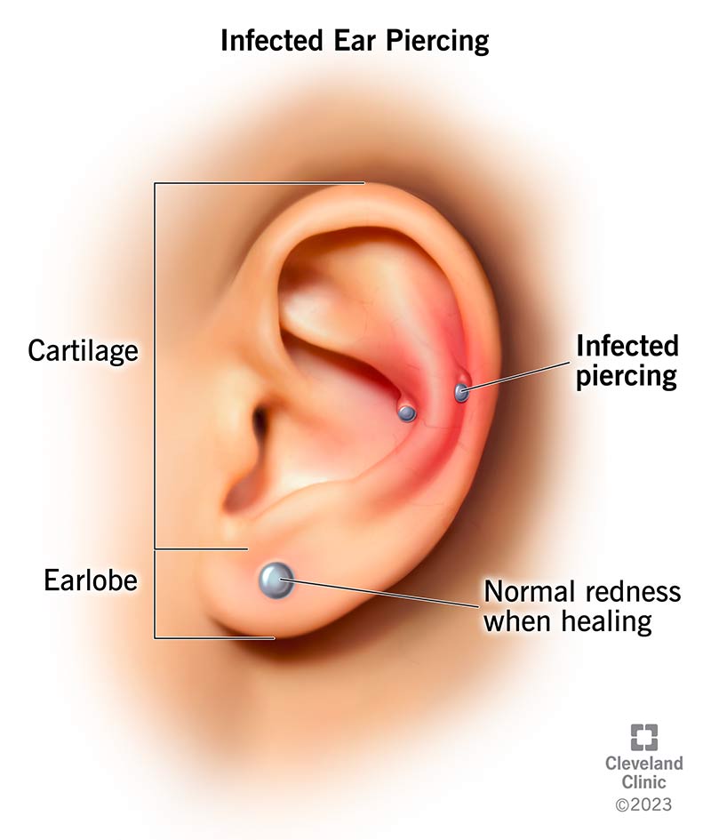 21503 infected ear piercing
