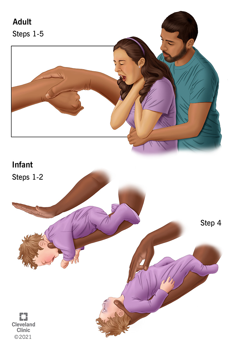 La manovra di Heimlich standard per gli adulti e metodi speciali utilizzati per soffocare i neonati.