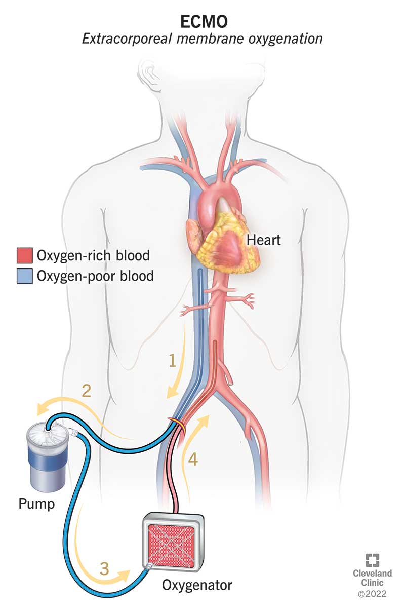 L'ECMO preleva il sangue dal corpo, aggiunge ossigeno e restituisce il sangue al corpo.