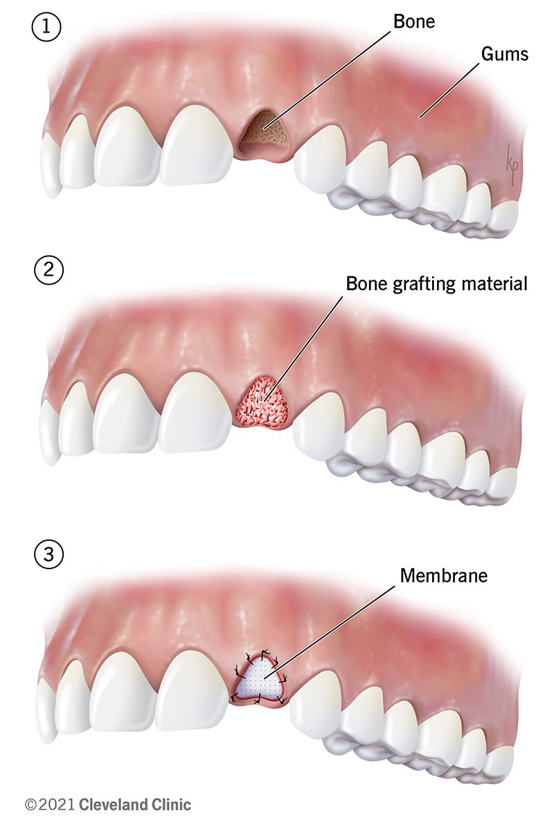 bocca che mostra la chirurgia dell'innesto osseo dentale