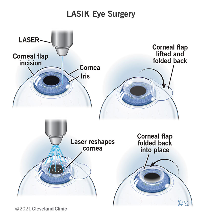 Illustrazione che mostra i passaggi di un intervento chirurgico agli occhi LASIK.