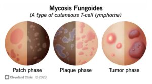 21827 mycosis fungoides