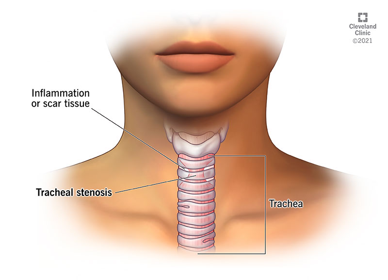 21866 tracheal stenosis