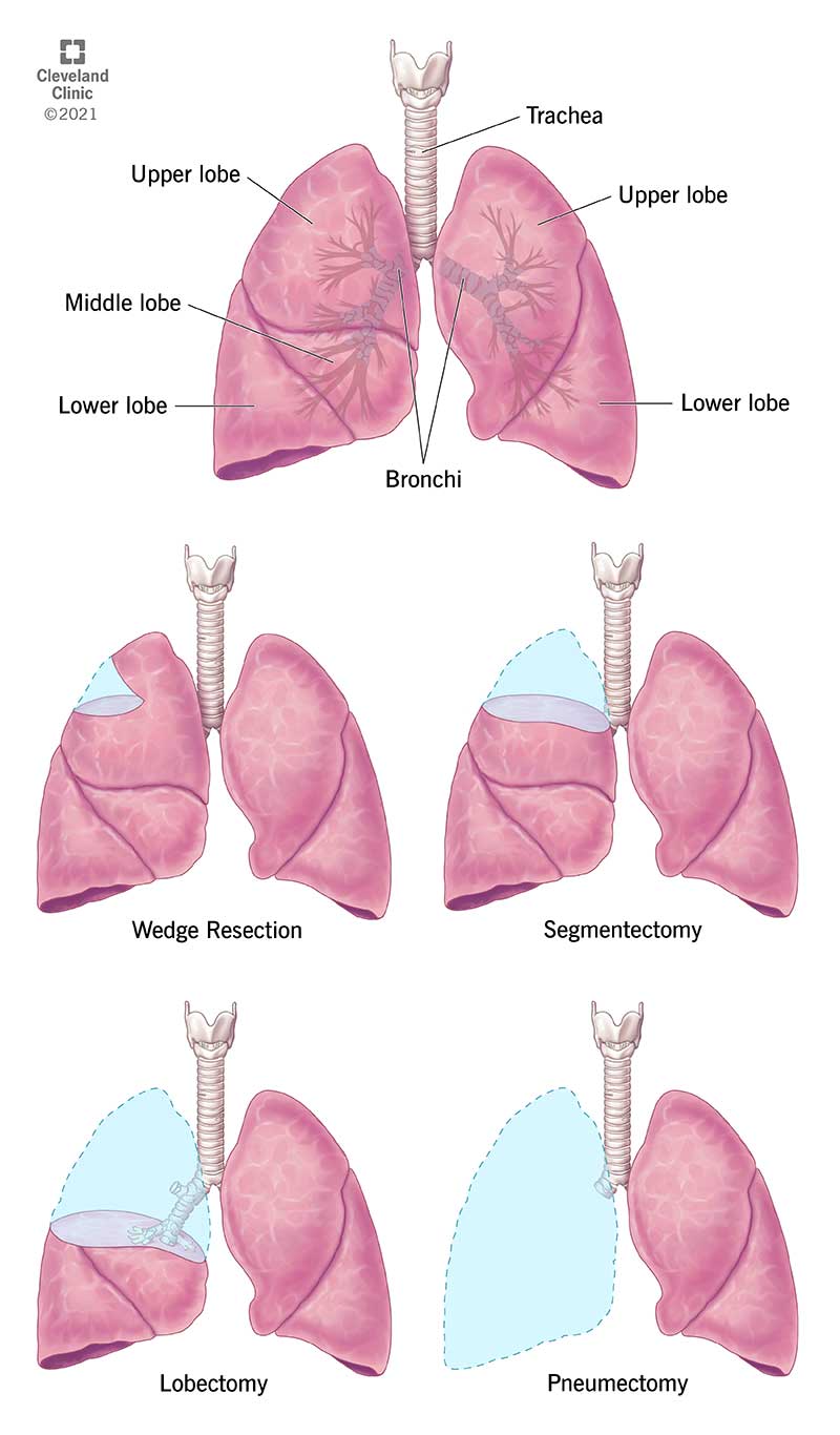 Diagramma dei polmoni ed esempi illustrativi di diversi tipi di resezione polmonare.
