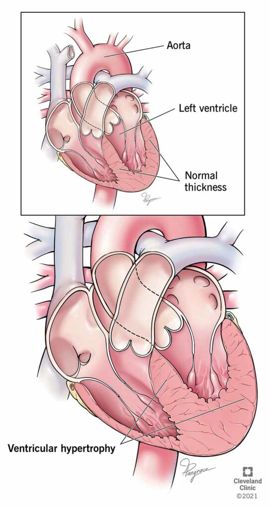 21883 left ventricular hypertrophy illustration