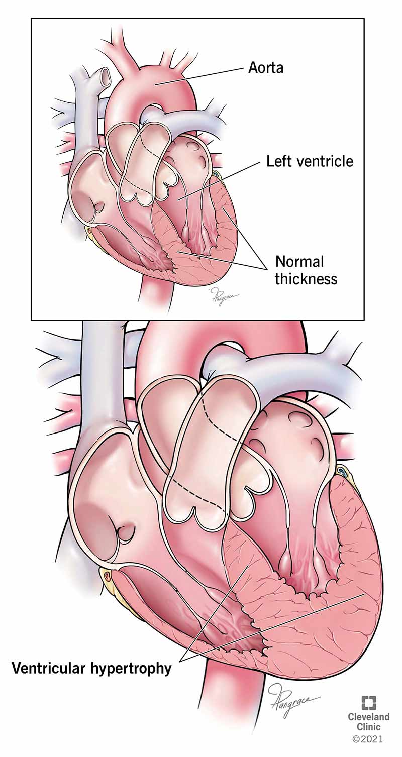 diagramma dell'ipertrofia ventricolare sinistra