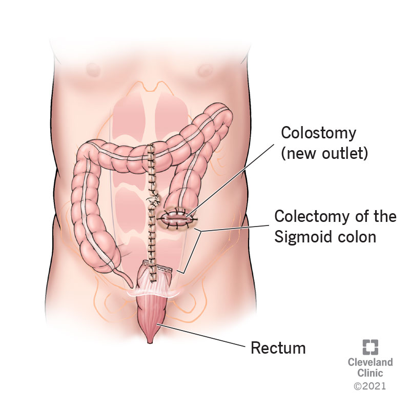 Procedura di Hartmann con colostomia e colectomia del colon sigmoideo