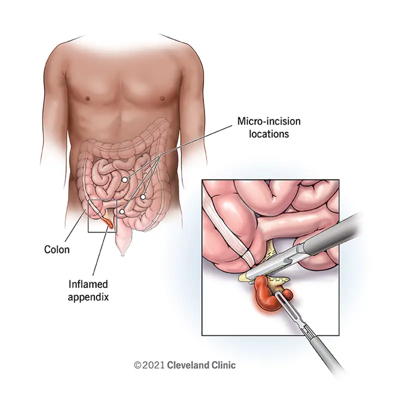 L’appendicectomia può spesso essere eseguita mediante chirurgia laparoscopica.  Un'appendice infiammata può essere raggiunta attraverso alcune piccole incisioni.