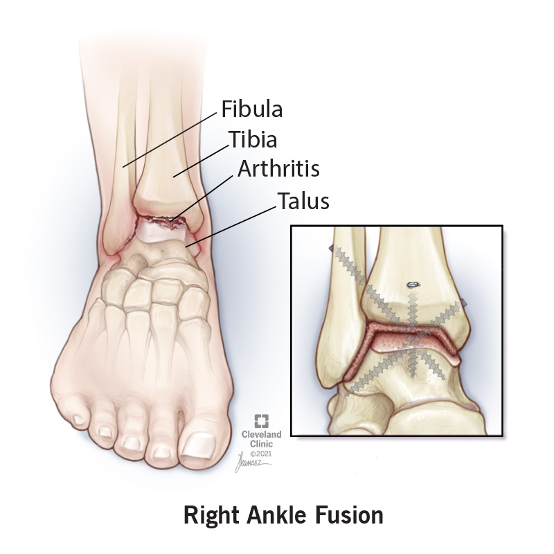 21928 ankle fusion