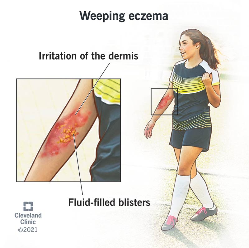 21991 weeping eczema