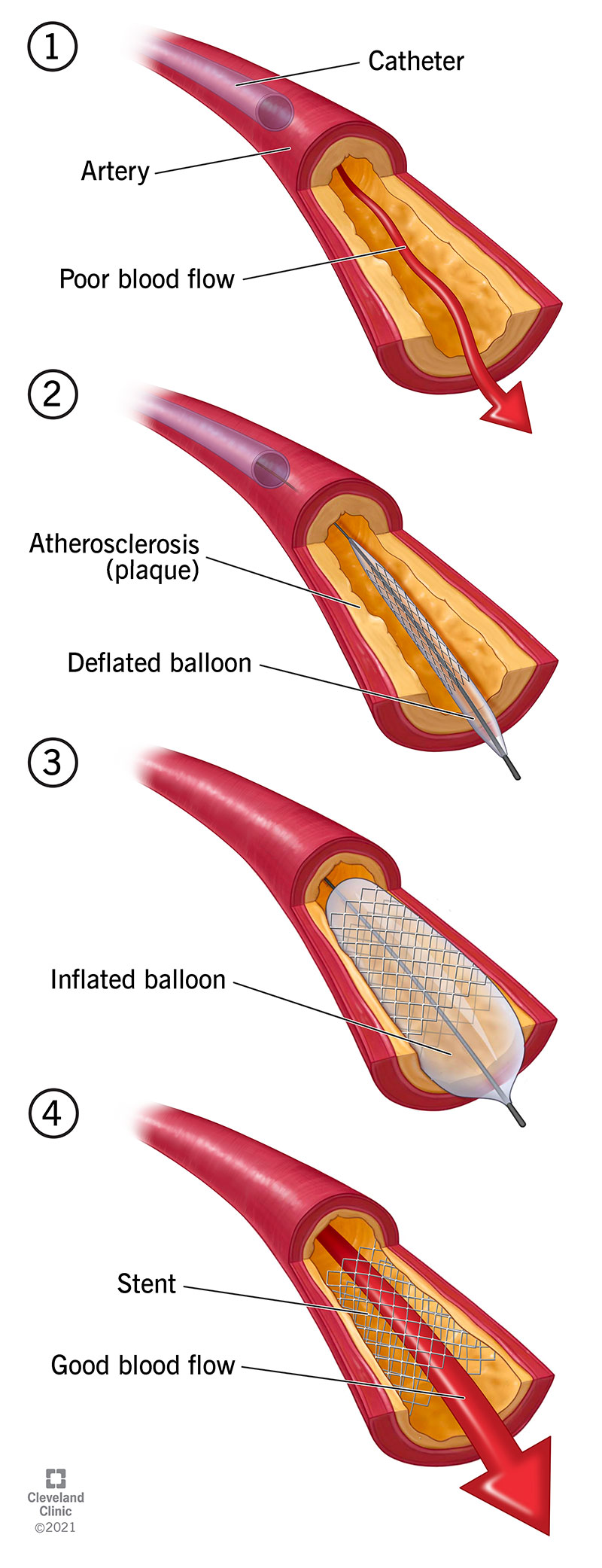 Un palloncino spinge la placca contro la parete dell'arteria.