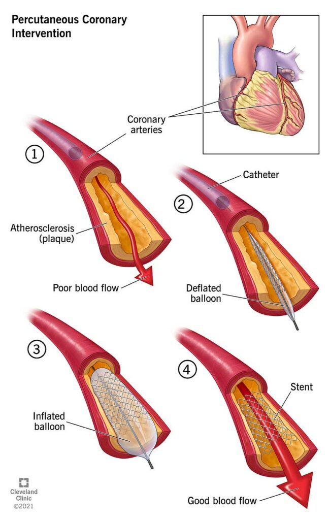 22066 percutaneous coronary intervention illustration